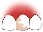 前歯が一本虫歯で侵されている状態。