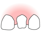 虫歯を取り除き、歯の周辺を削り、型取りをします。